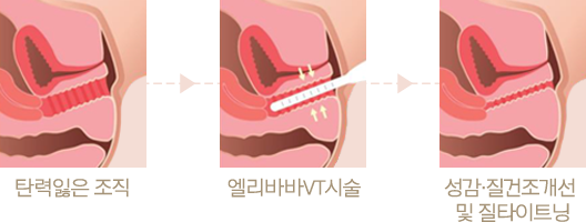 탄력잃은 조직 > 엘리바바VT시술 > 성감,질건조개선 및 질타이트닝