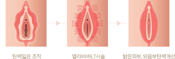 탄력잃은 조직 > 엘리바바LT시술 > 밝은피부, 외음부탄력개선